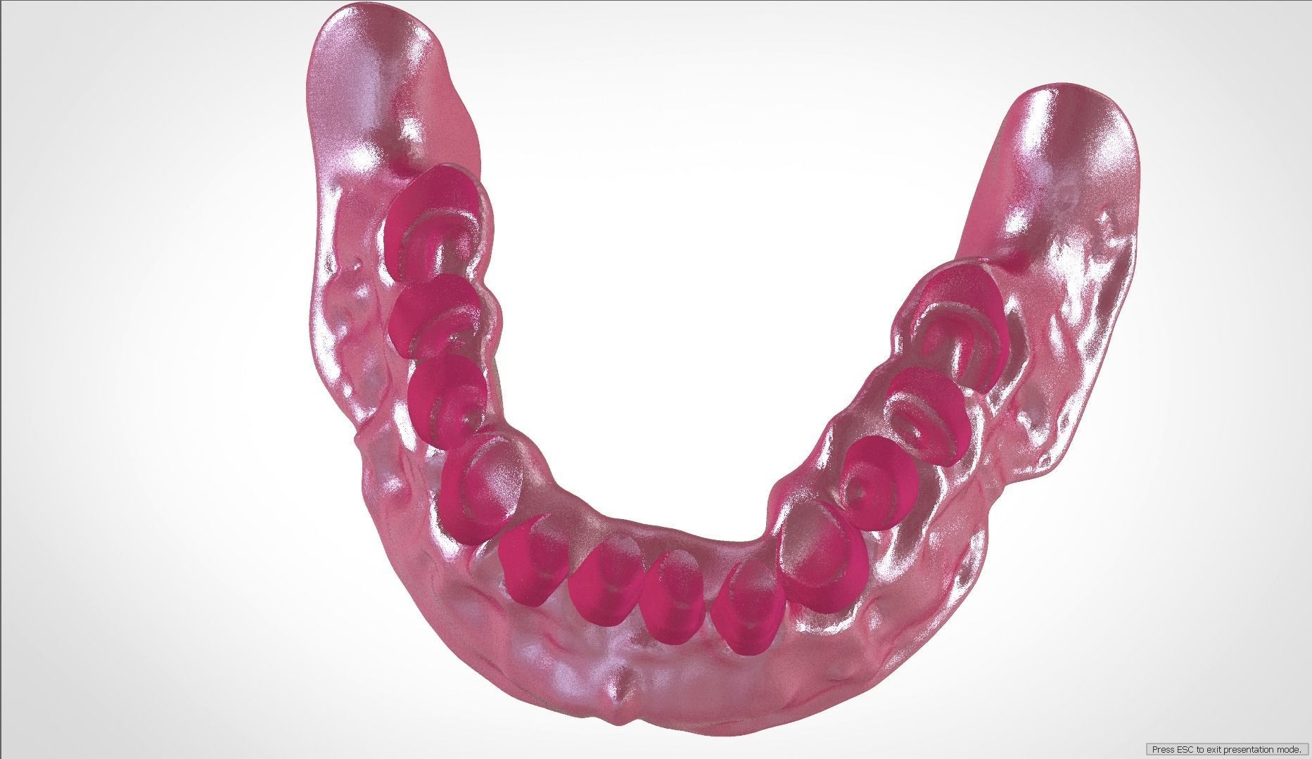 Digital Full Dentures for Gluedin Teeth with Manual Reduction 3D print model_31