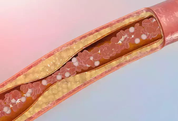 blocked blood vessel animation