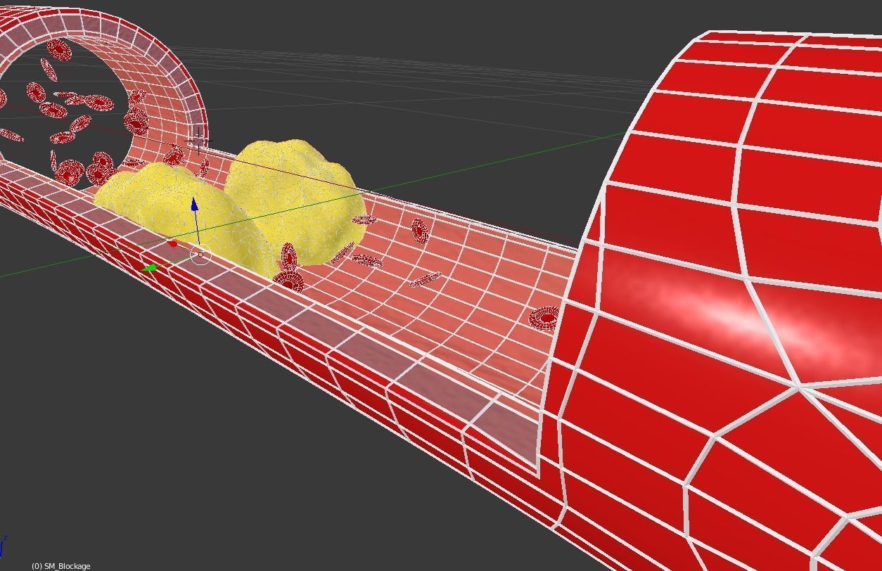 Detail of a clogged artery - animated 3D model_4