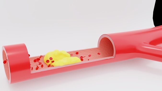 Detail of a clogged artery - animated 3D model