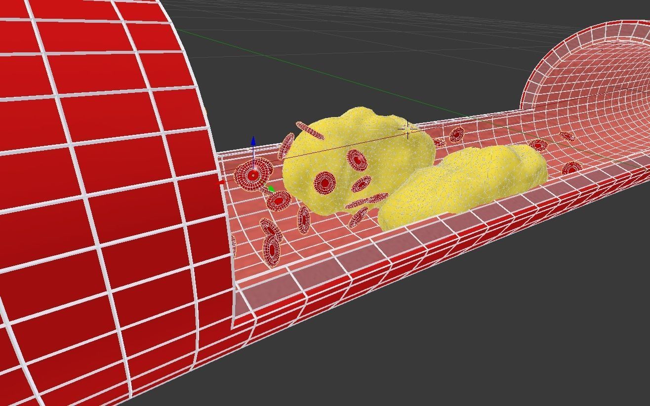 Detail of a clogged artery - animated 3D model_3