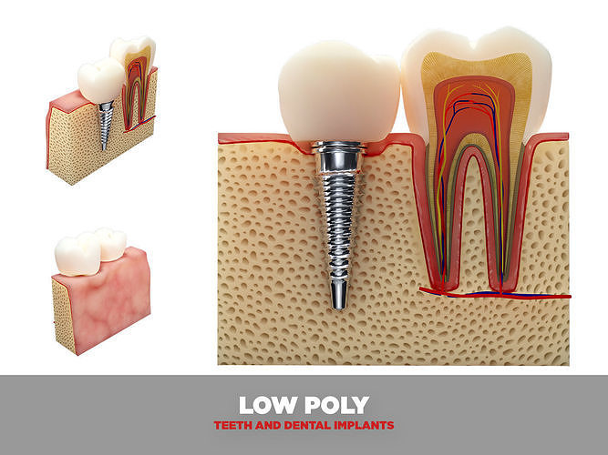 Teeth and dental implants Low-poly 3D model