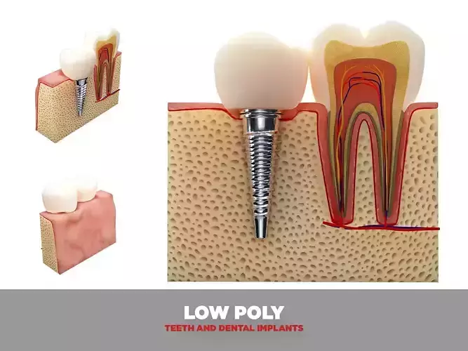 Teeth and dental implants Low-poly 3D model