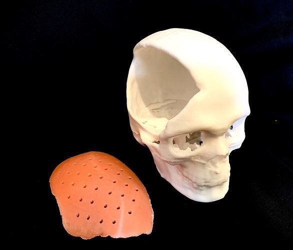Craniofacial Implant  3D print model