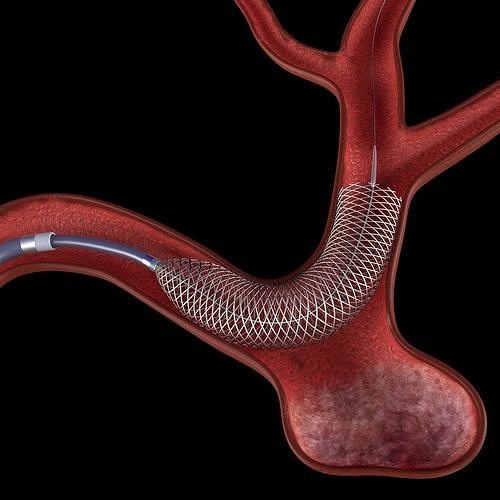 Flow diverter stent in aneurysm 3D model