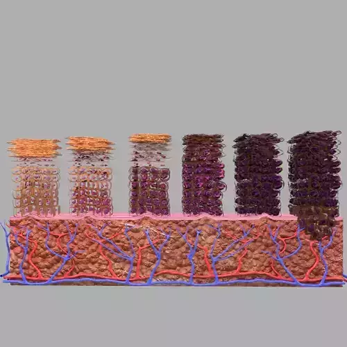 Cervical cancer dysplasia CIN