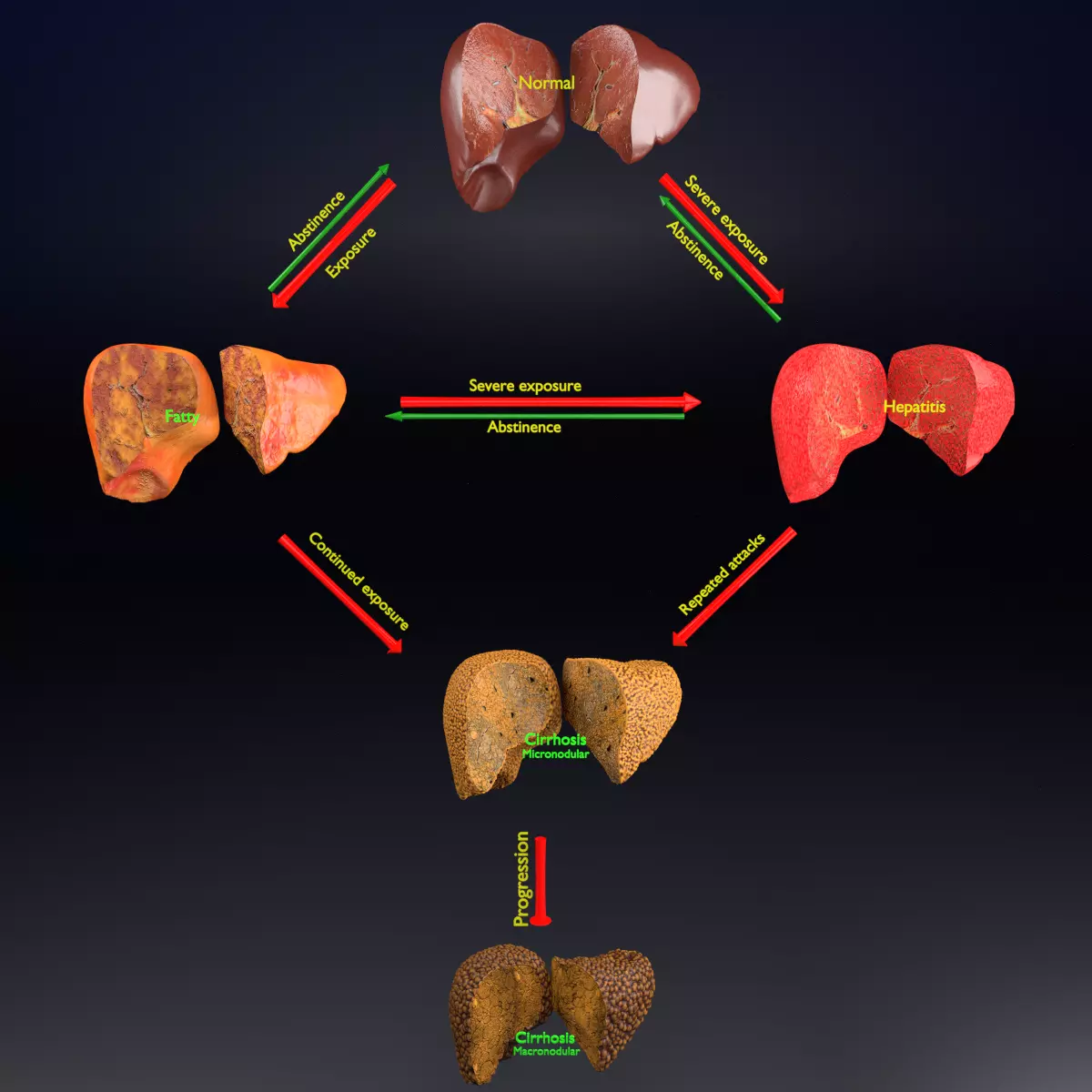 Alchoholic liver disease cirrhosis hepatitis fatty 3D model_0