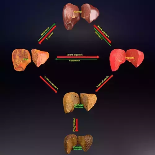 Alchoholic liver disease cirrhosis hepatitis fatty