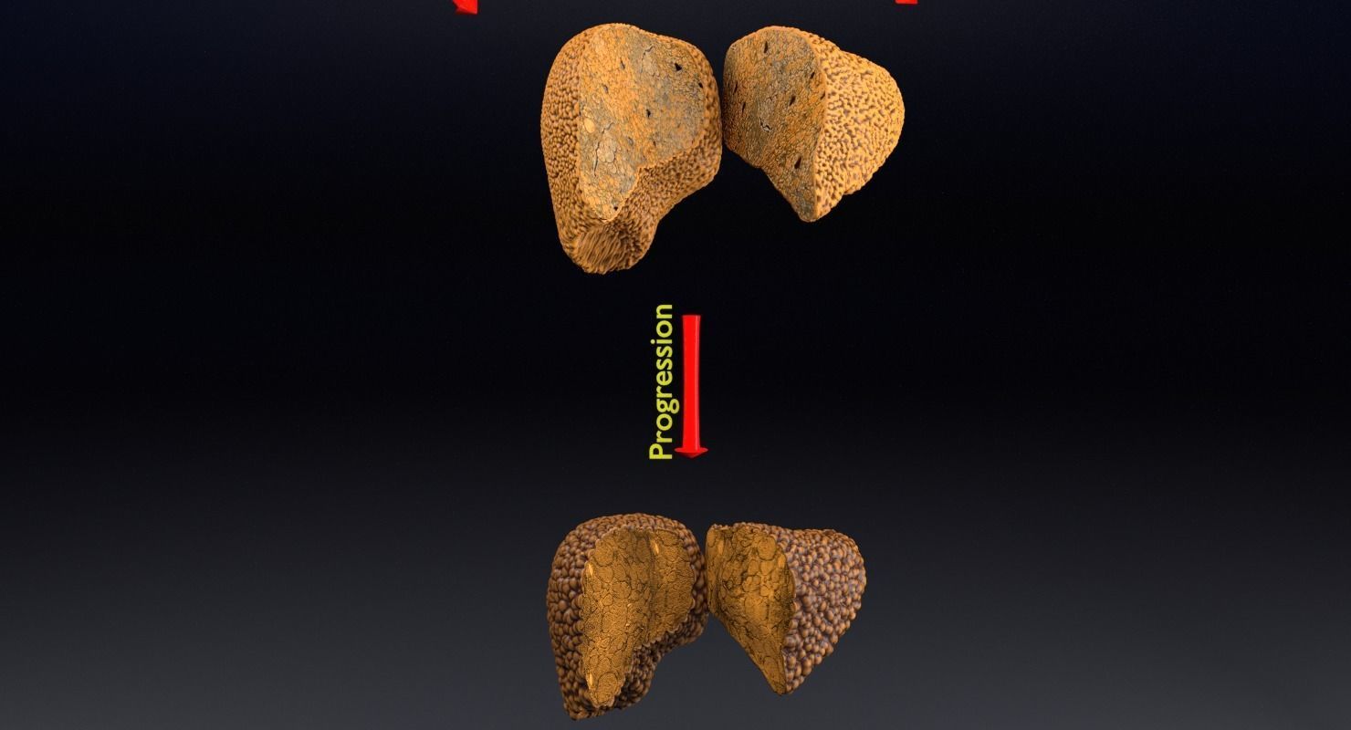 Alchoholic liver disease cirrhosis hepatitis fatty 3D model_12