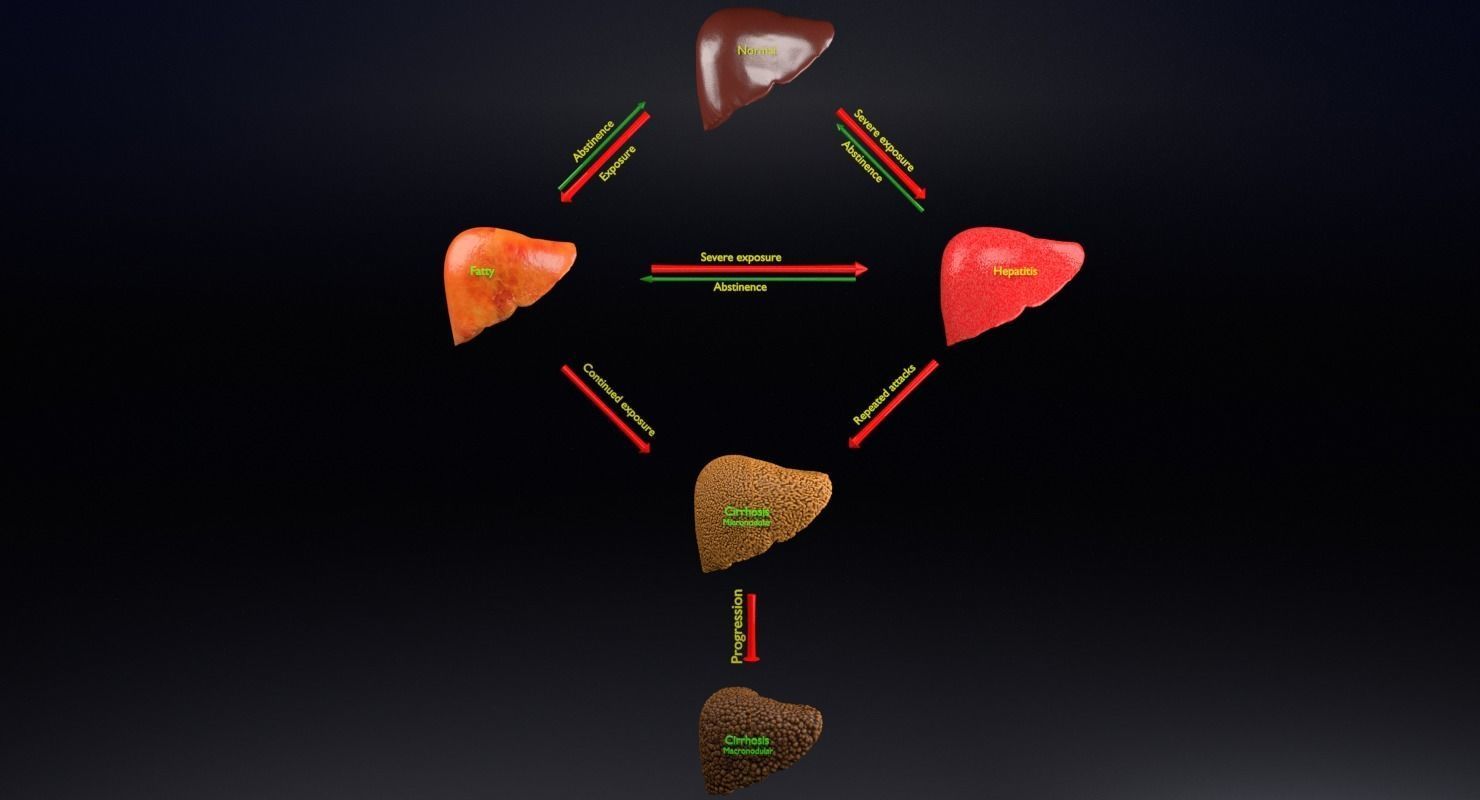 Alchoholic liver disease cirrhosis hepatitis fatty 3D model_8