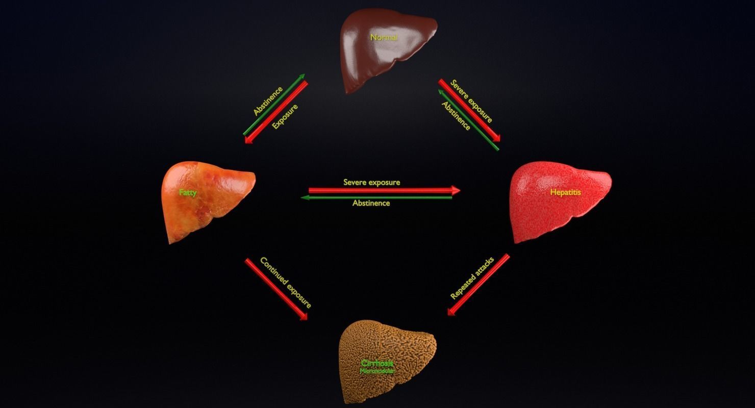 Alchoholic liver disease cirrhosis hepatitis fatty 3D model_17