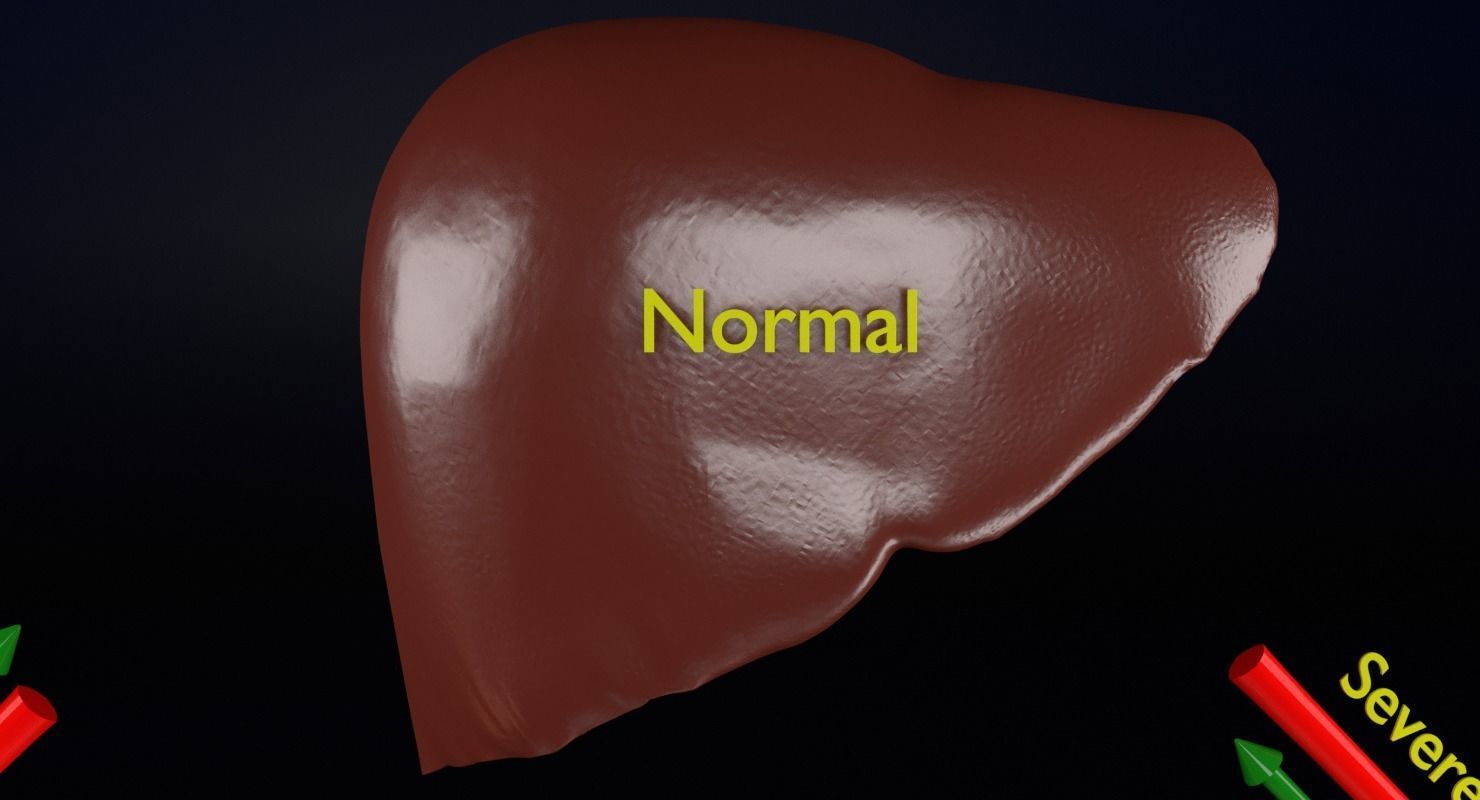 Alchoholic liver disease cirrhosis hepatitis fatty 3D model_18