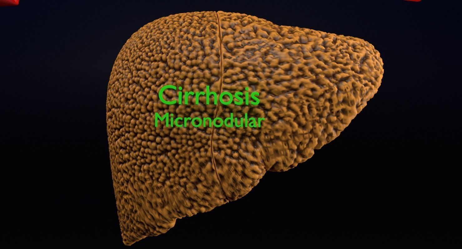 Alchoholic liver disease cirrhosis hepatitis fatty 3D model_5