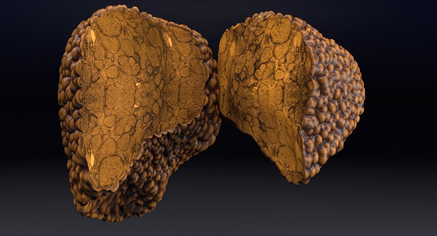 Alchoholic liver disease cirrhosis hepatitis fatty 3D model_6
