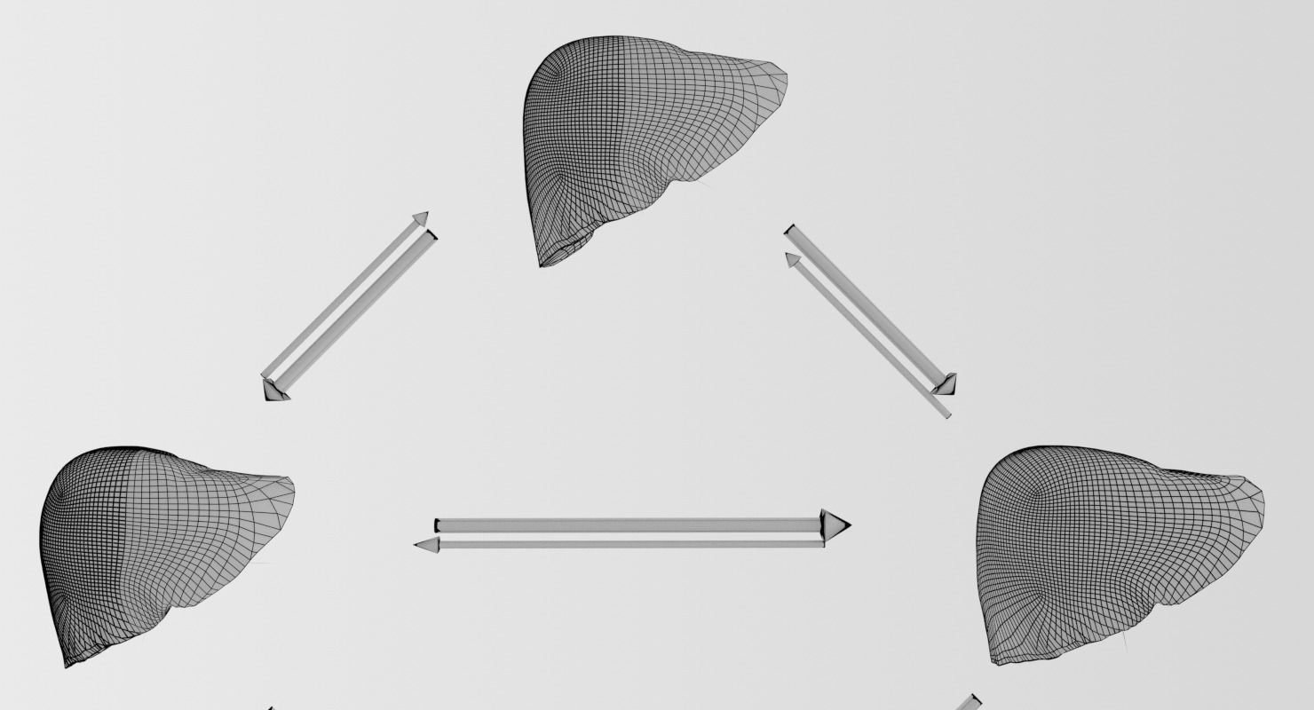 Alchoholic liver disease cirrhosis hepatitis fatty 3D model_24