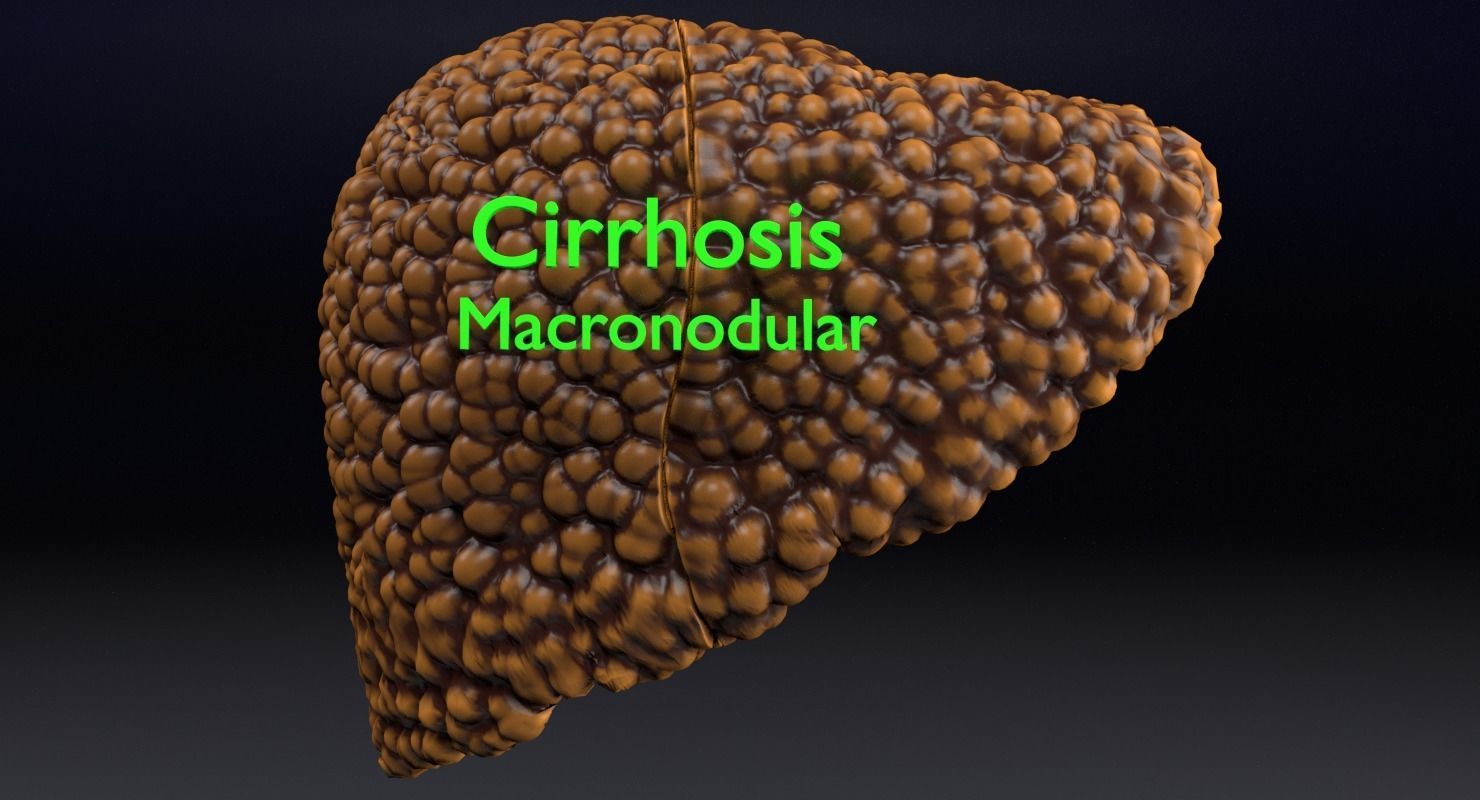 Alchoholic liver disease cirrhosis hepatitis fatty 3D model_7