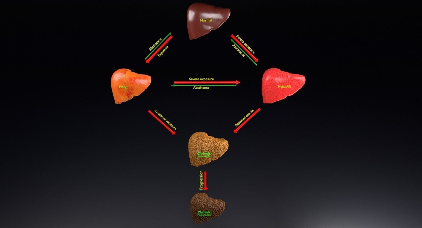 Alchoholic liver disease cirrhosis hepatitis fatty 3D model_11