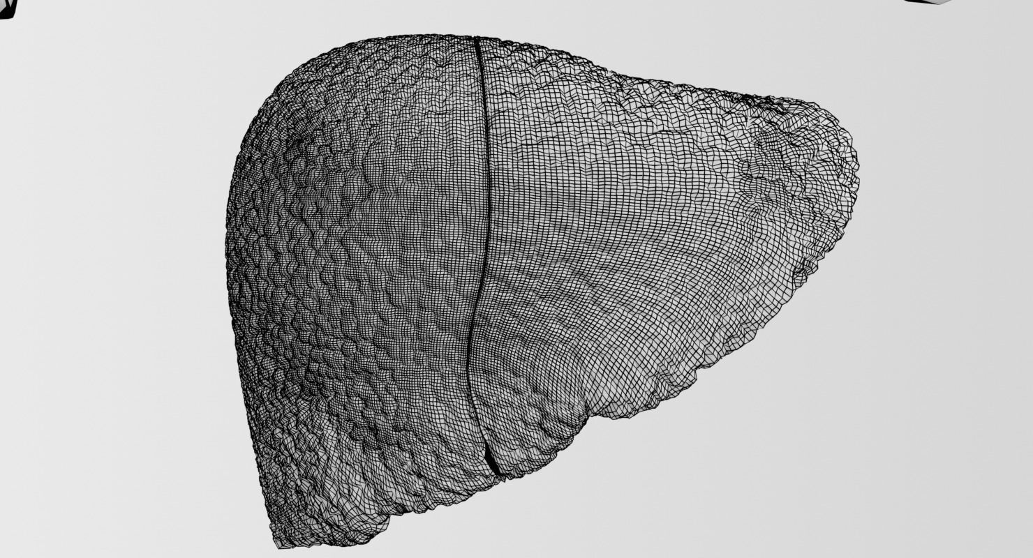 Alchoholic liver disease cirrhosis hepatitis fatty 3D model_29