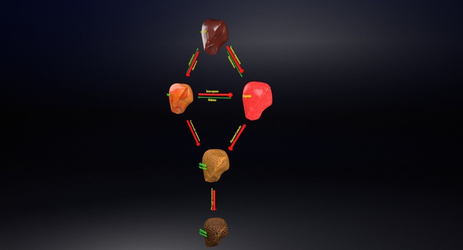 Alchoholic liver disease cirrhosis hepatitis fatty 3D model_15