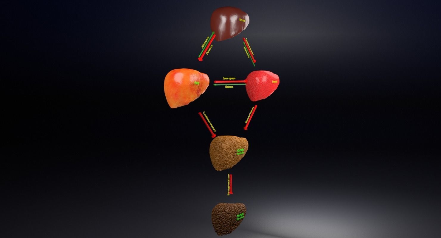 Alchoholic liver disease cirrhosis hepatitis fatty 3D model_16