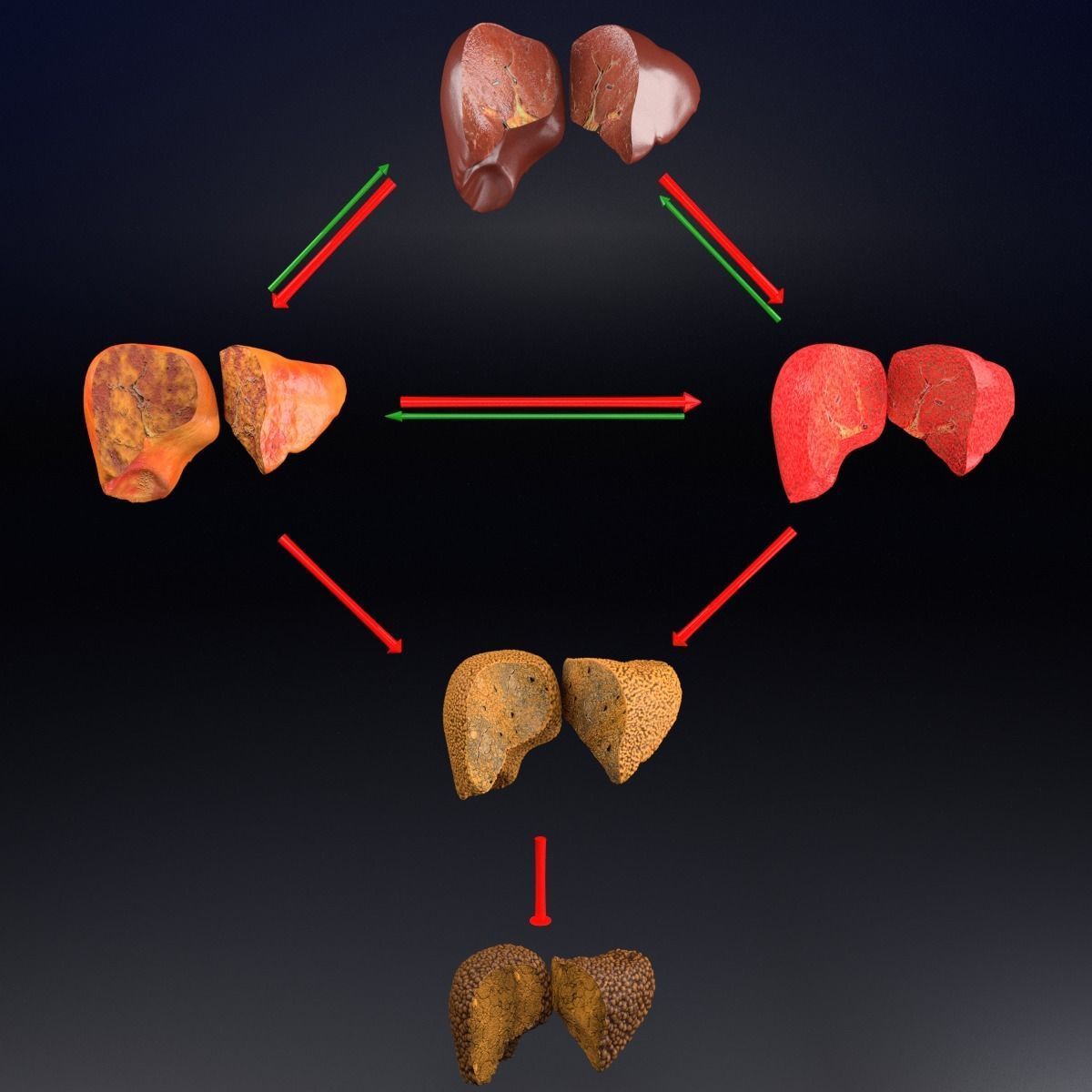Alchoholic liver disease cirrhosis hepatitis fatty 3D model_14