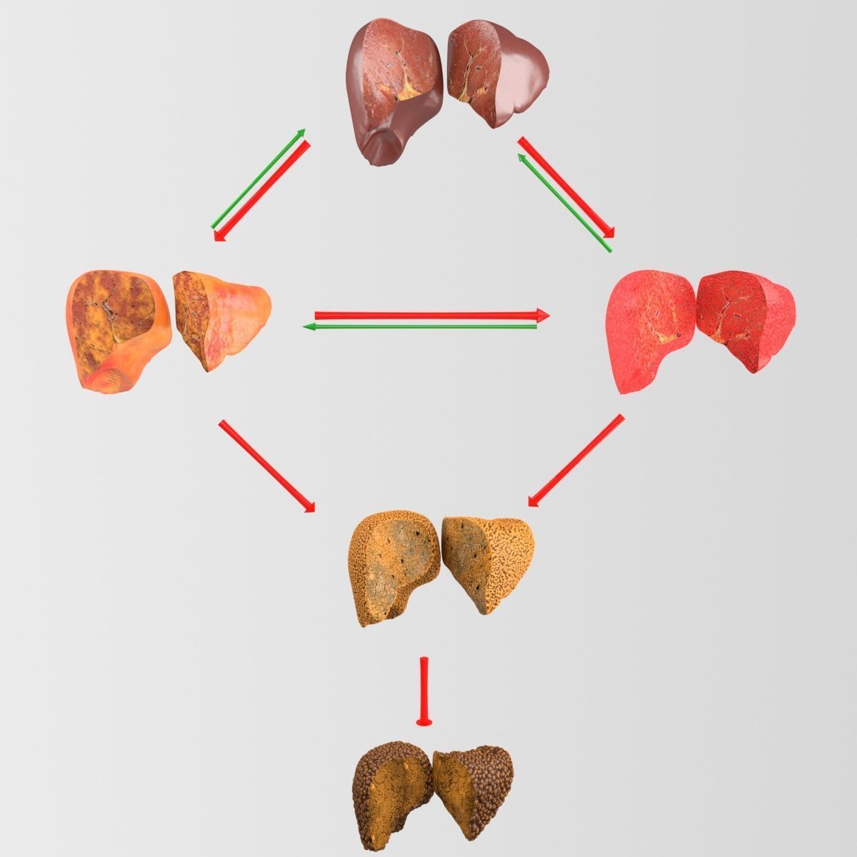 Alchoholic liver disease cirrhosis hepatitis fatty 3D model_3