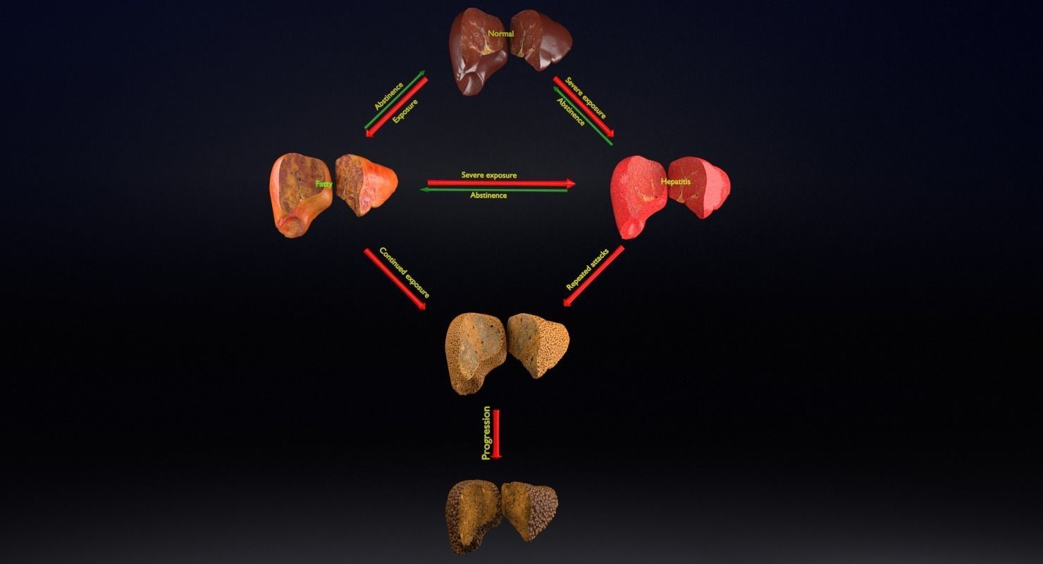 Alchoholic liver disease cirrhosis hepatitis fatty 3D model_10