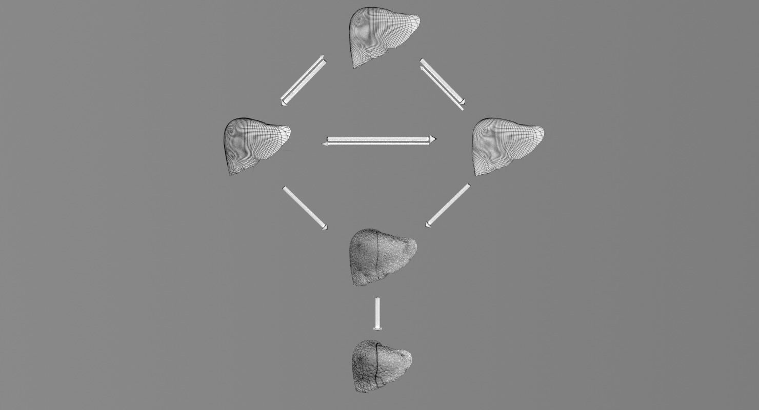 Alchoholic liver disease cirrhosis hepatitis fatty 3D model_23
