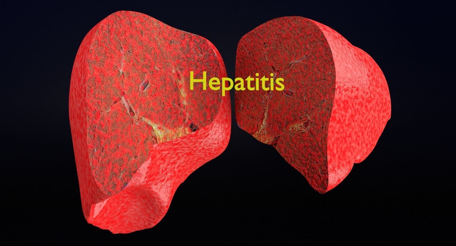 Alchoholic liver disease cirrhosis hepatitis fatty 3D model_9