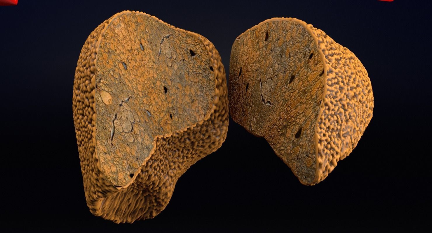 Alchoholic liver disease cirrhosis hepatitis fatty 3D model_4