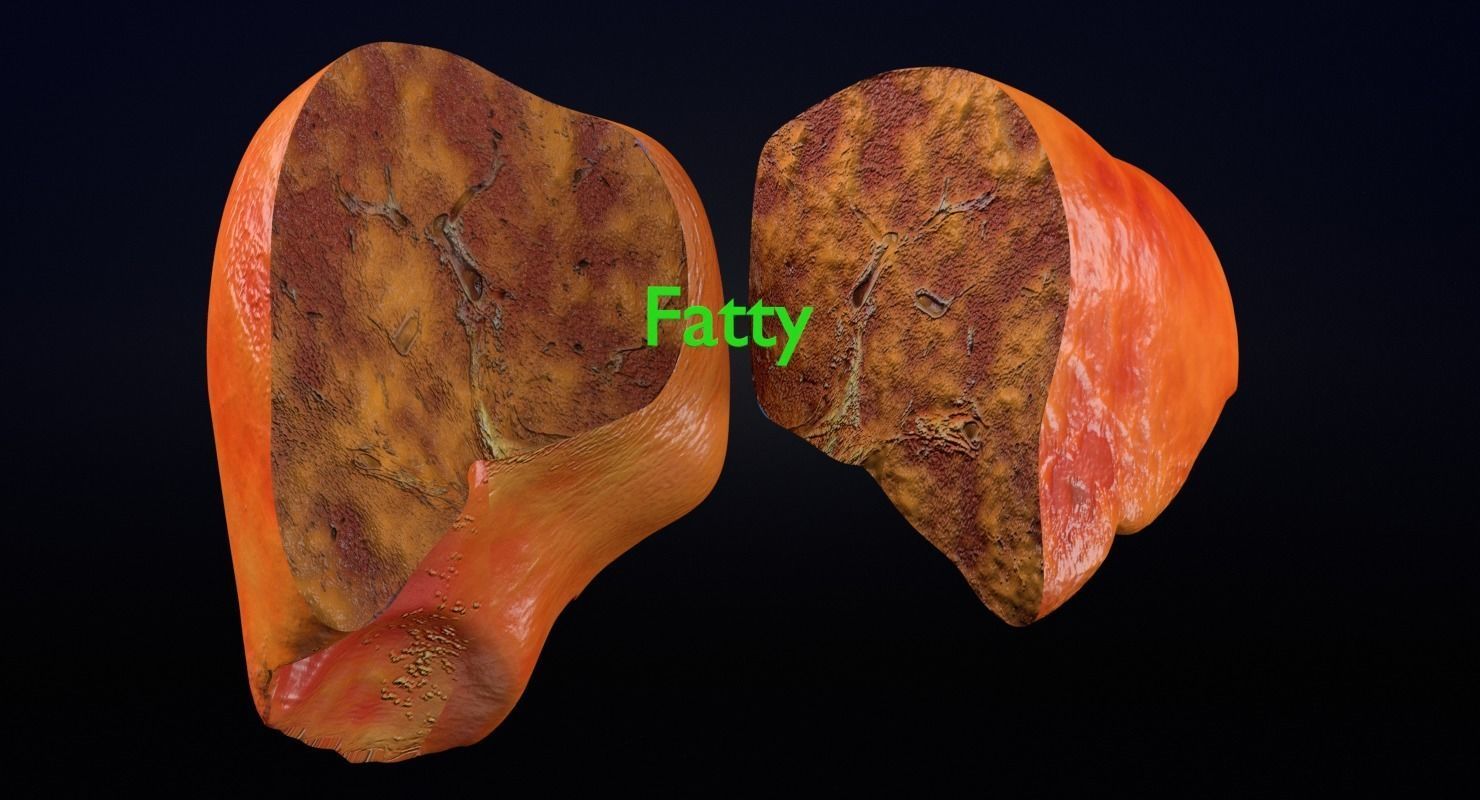 Alchoholic liver disease cirrhosis hepatitis fatty 3D model_21