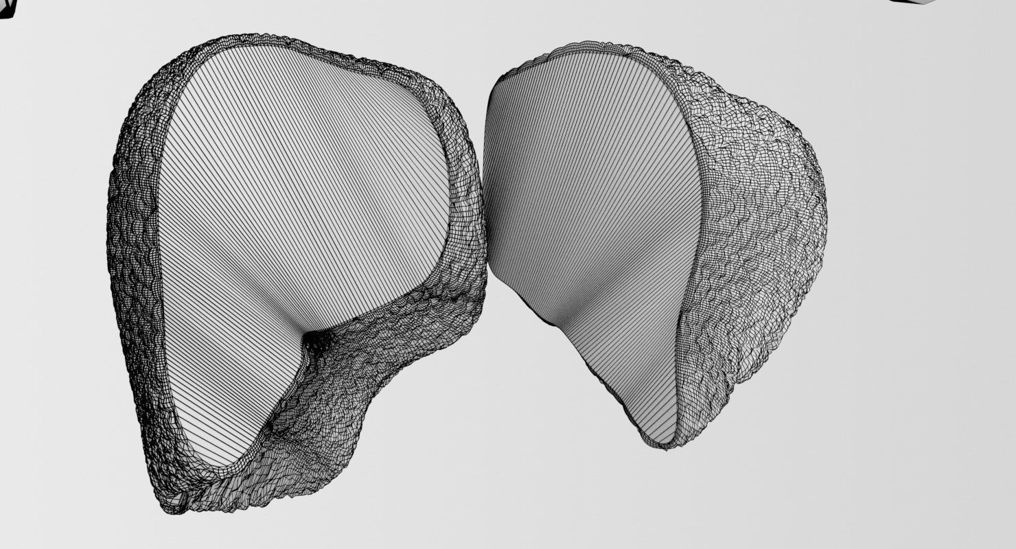 Alchoholic liver disease cirrhosis hepatitis fatty 3D model_30