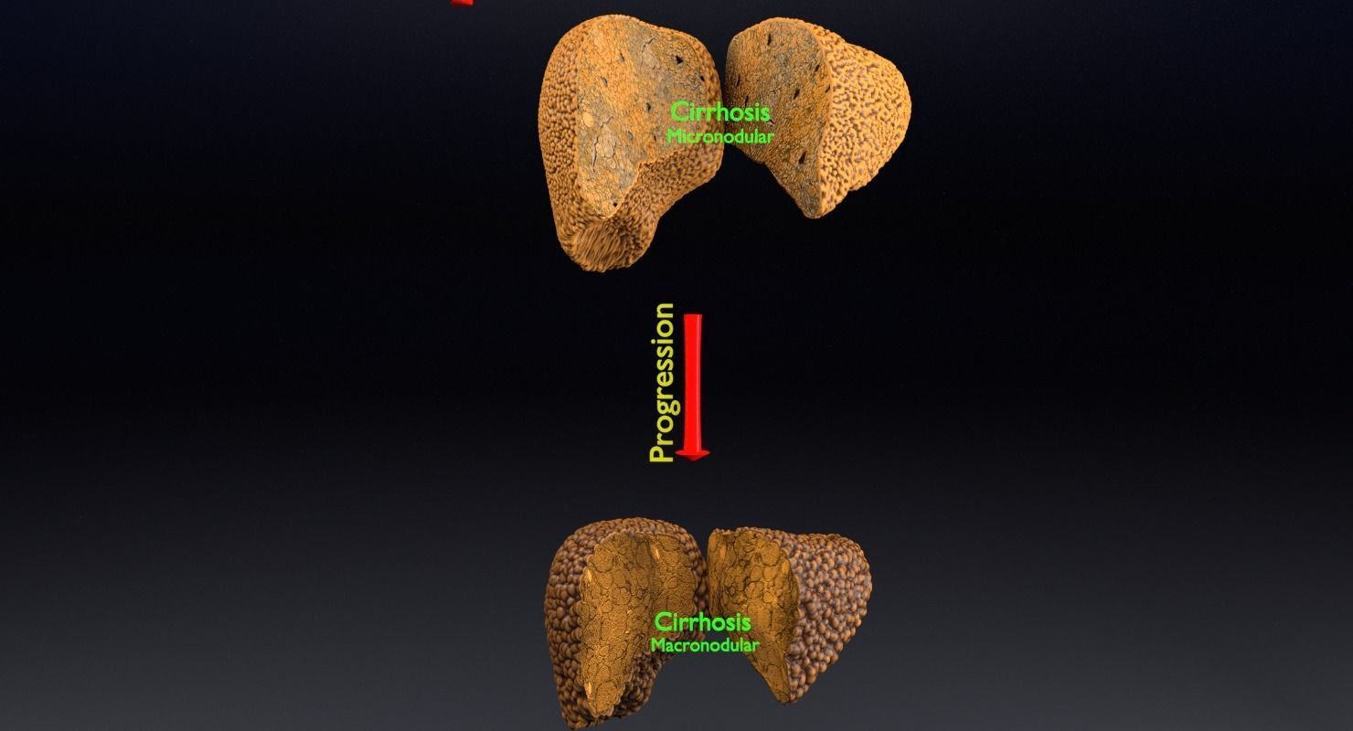 Alchoholic liver disease cirrhosis hepatitis fatty 3D model_13