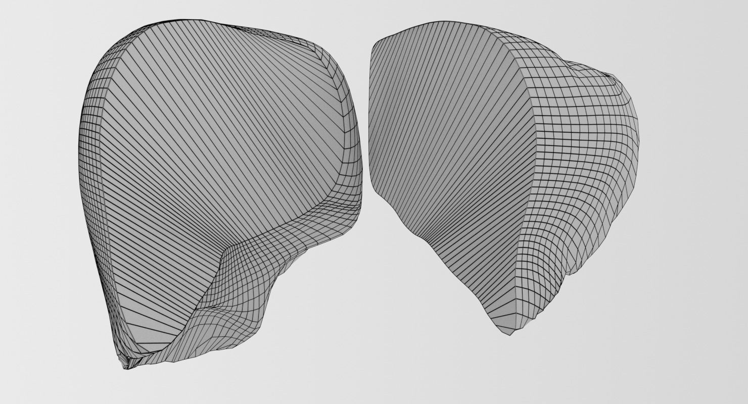 Alchoholic liver disease cirrhosis hepatitis fatty 3D model_27