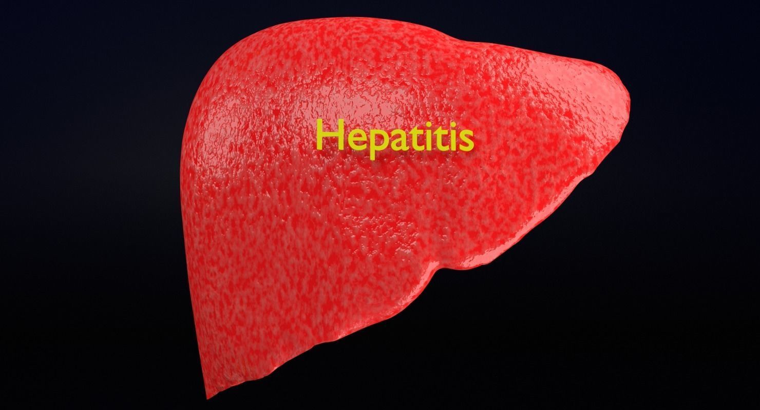 Alchoholic liver disease cirrhosis hepatitis fatty 3D model_22