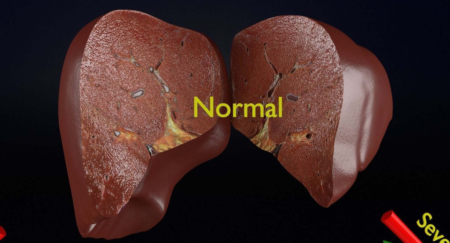 Alchoholic liver disease cirrhosis hepatitis fatty 3D model_19