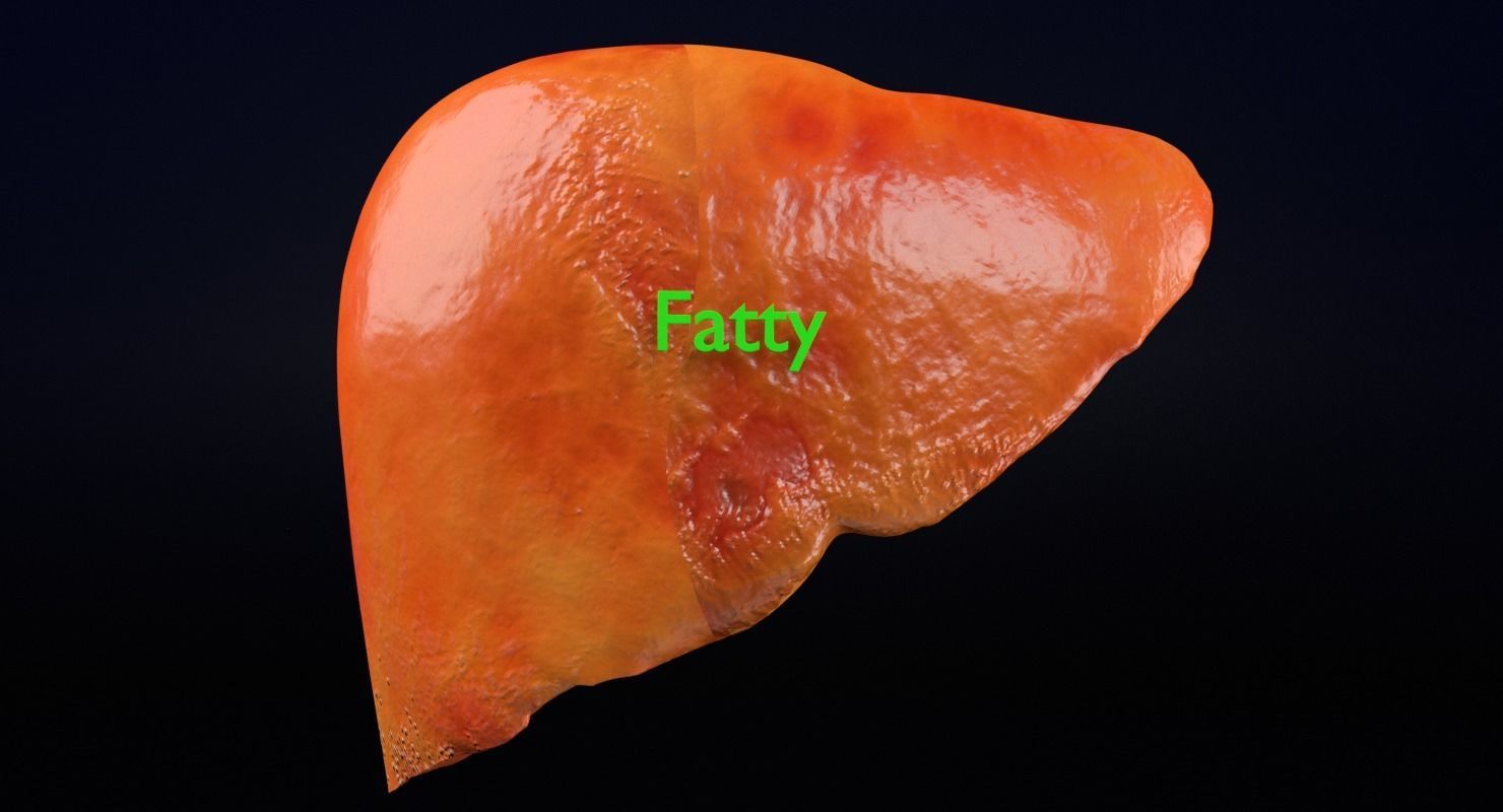 Alchoholic liver disease cirrhosis hepatitis fatty 3D model_20