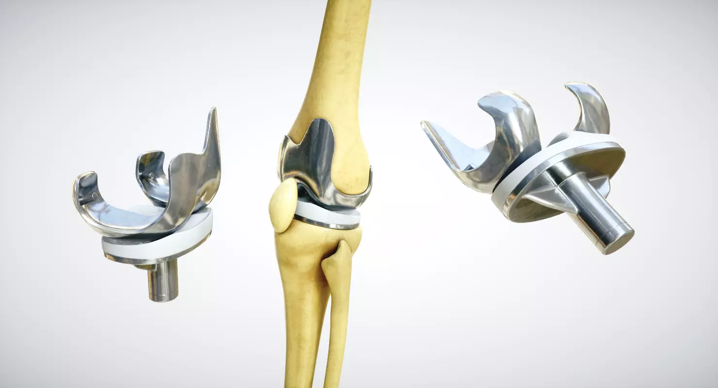 Knee endoprosthesis Low-poly 3D model_0
