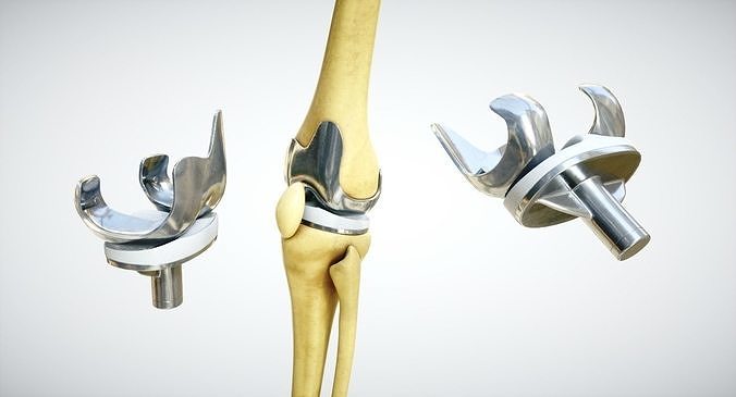 Knee endoprosthesis Low-poly 3D model