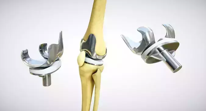 Knee endoprosthesis Low-poly 3D model