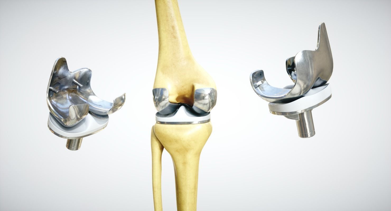 Knee endoprosthesis Low-poly 3D model_1