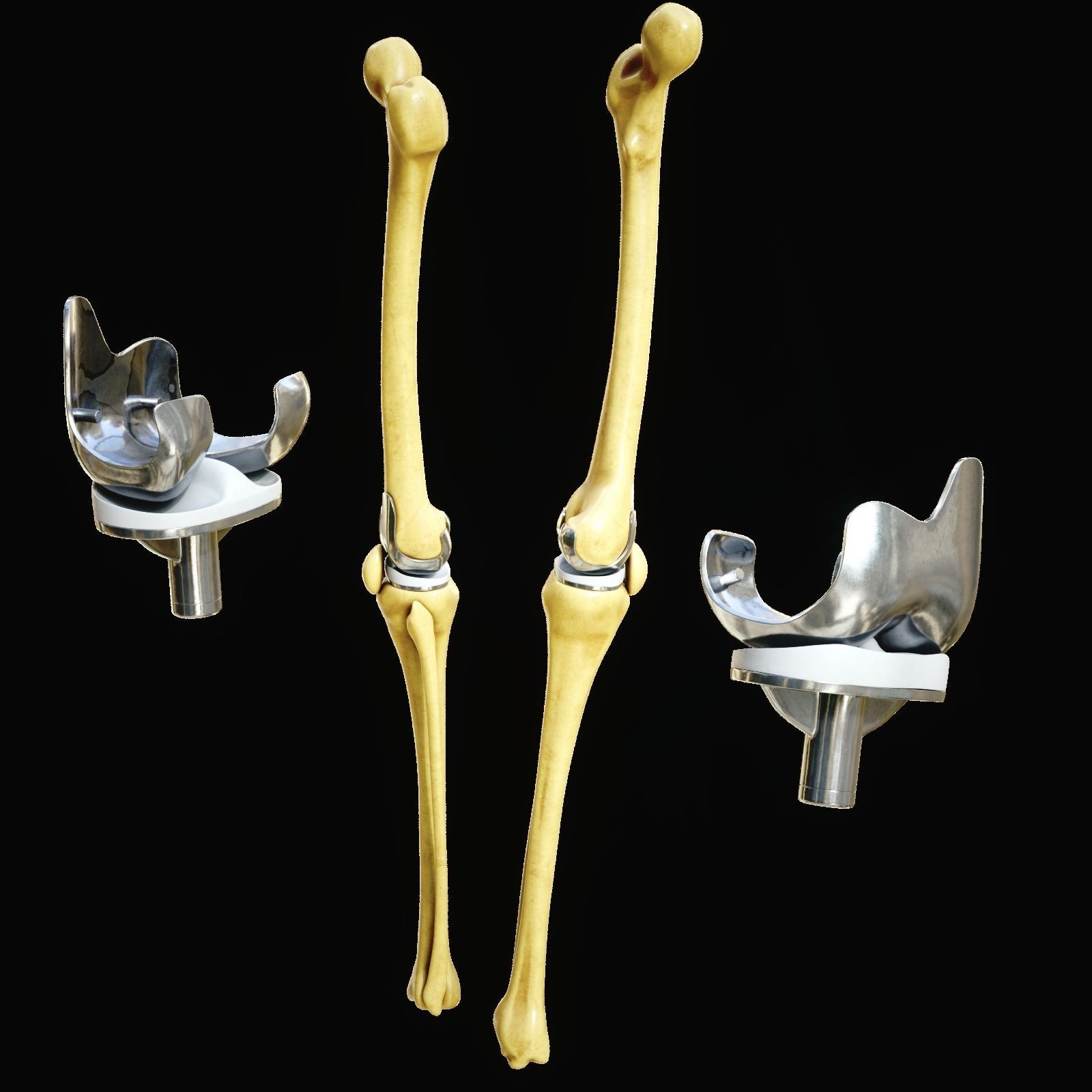 Knee endoprosthesis Low-poly 3D model_3