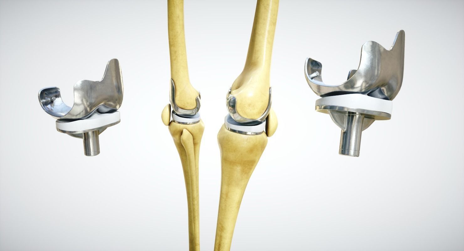 Knee endoprosthesis Low-poly 3D model_2