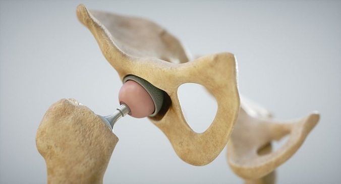 Medical 3D Print Hip-Joint  Low-poly 3D model