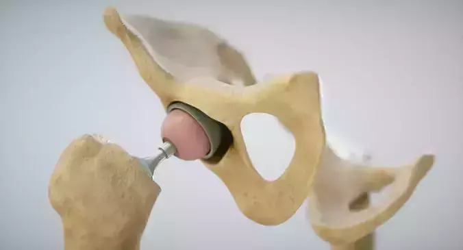 Medical 3D Print Hip-Joint  Low-poly 3D model