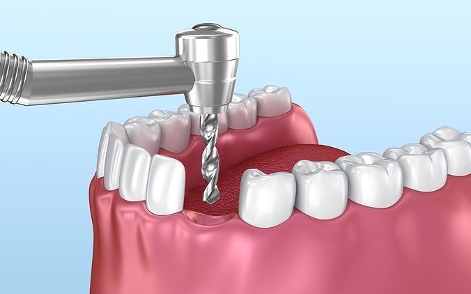 Dental implant animated instalation  3D model