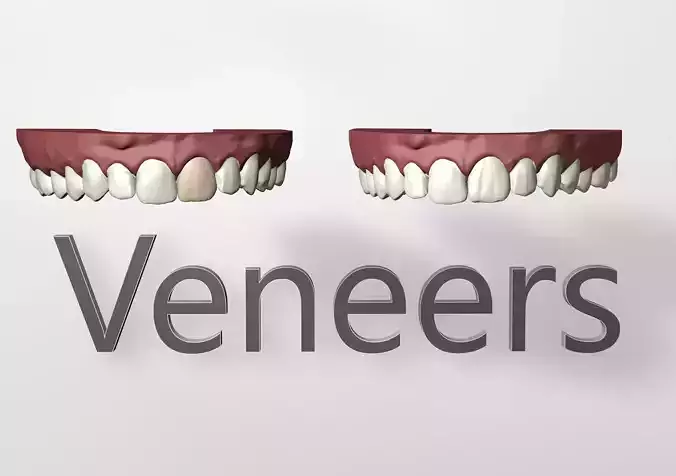Dental teeth veneers 3D model