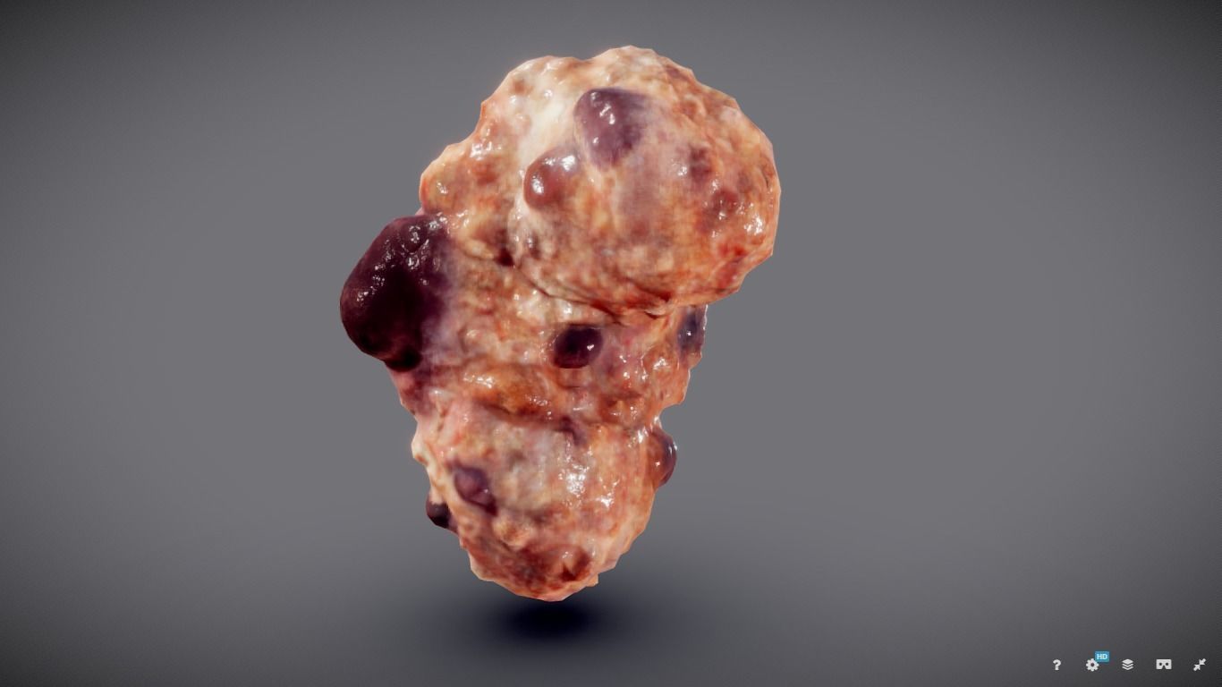 Polycistic Kidney Low-poly 3D model_2
