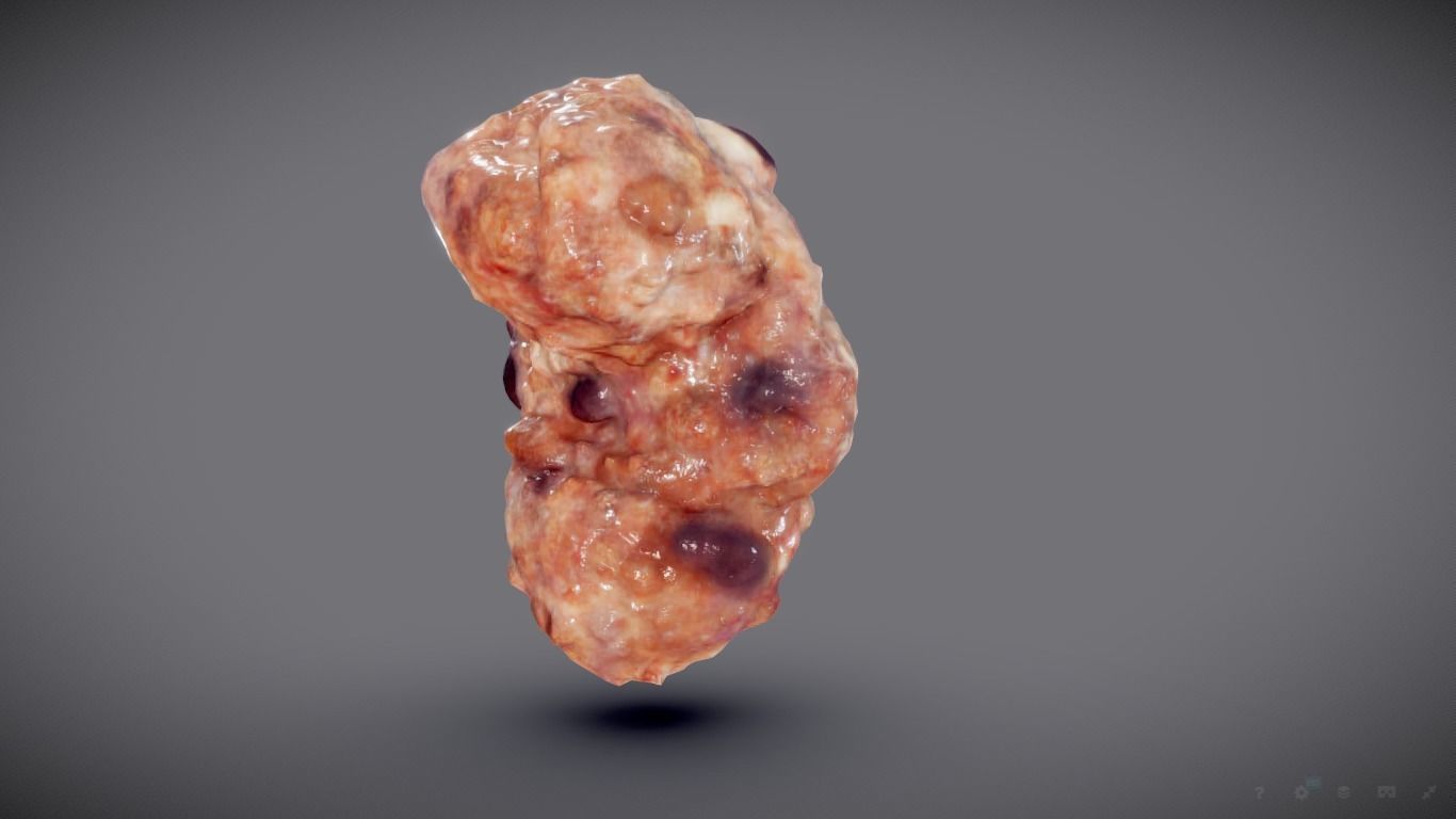 Polycistic Kidney Low-poly 3D model_4
