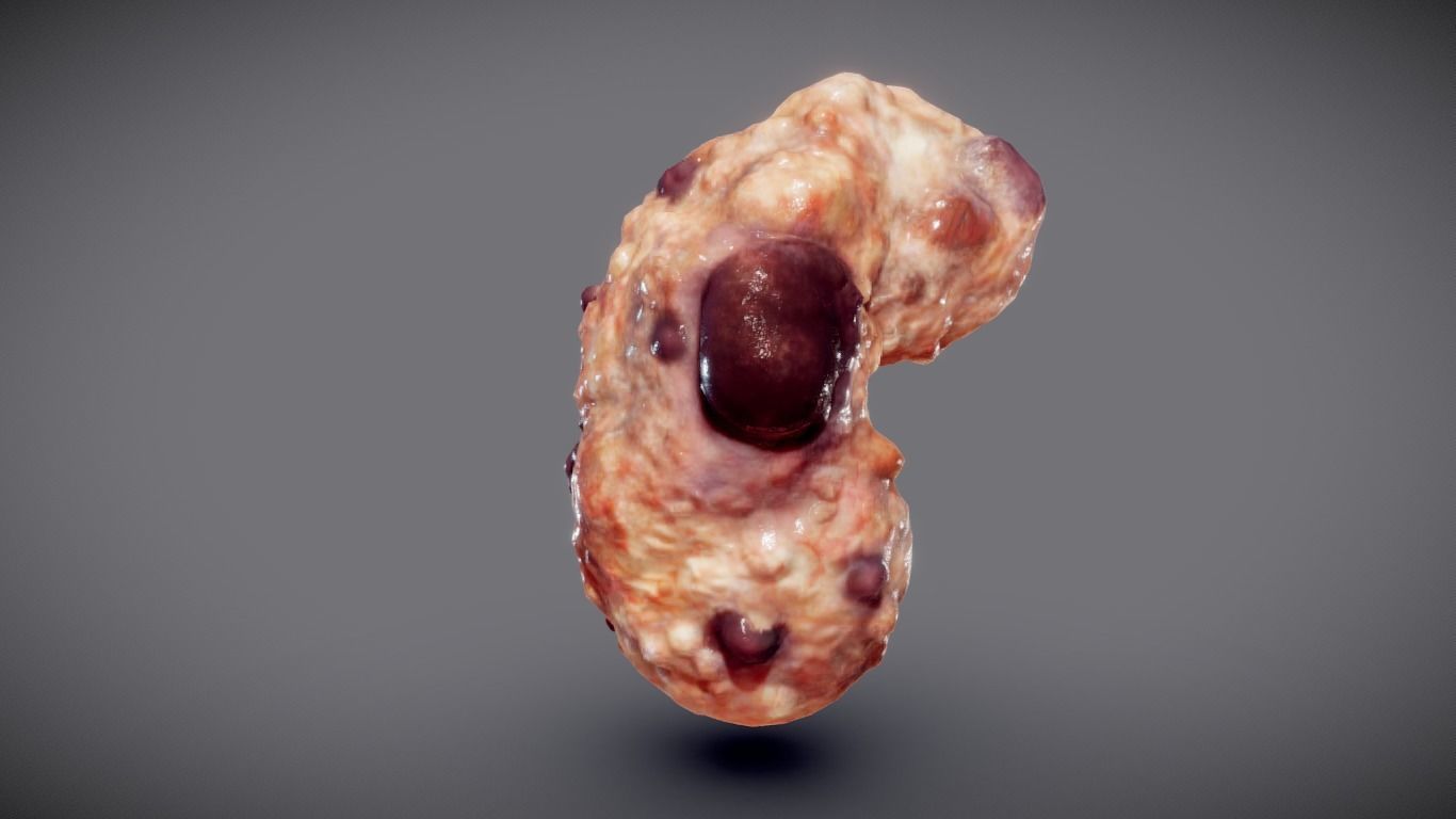 Polycistic Kidney Low-poly 3D model_11